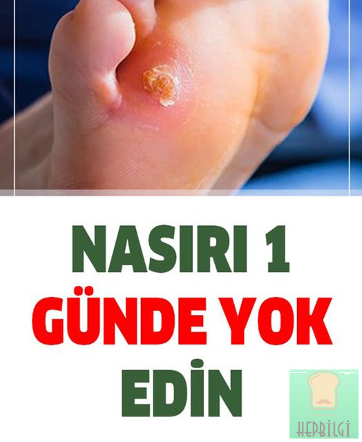 İşte Nasırdan 1 Günde Kurtaracak Doğal Tedavi Yöntemleri - 1